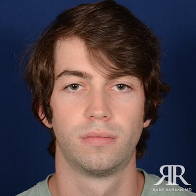 Chin Augmentation Before & After Gallery - Patient 301607 - Image 1