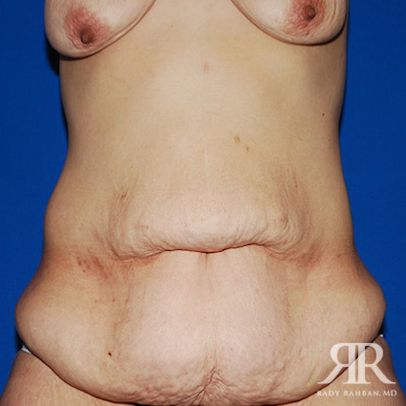 Tummy Tuck Before & After Gallery - Patient 364388 - Image 1