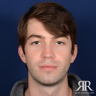 Chin Augmentation Before & After Gallery - Patient 301607 - Image 2