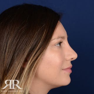 Female Rhinoplasty Before & After Gallery - Patient 378780 - Image 6