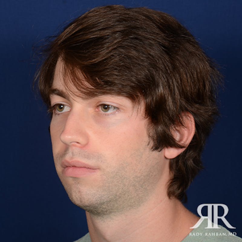 Chin Augmentation Before & After Gallery - Patient 301607 - Image 3