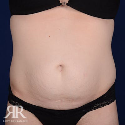 Severe Diastasis Recti Before & After Gallery - Patient 305980 - Image 1