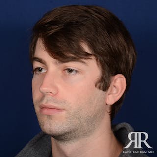 Chin Augmentation Before & After Gallery - Patient 301607 - Image 4