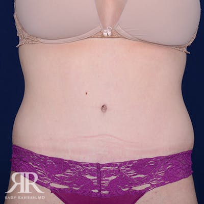Severe Diastasis Recti Before & After Gallery - Patient 305980 - Image 2