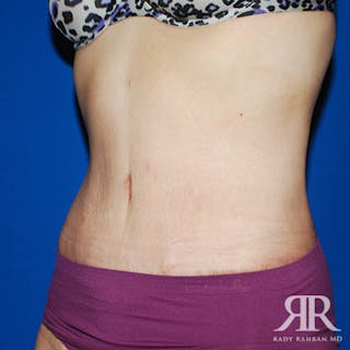 Tummy Tuck Before & After Gallery - Patient 364388 - Image 4