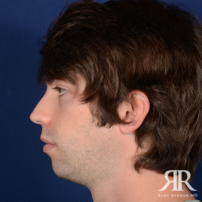 Chin Augmentation Before & After Gallery - Patient 301607 - Image 5