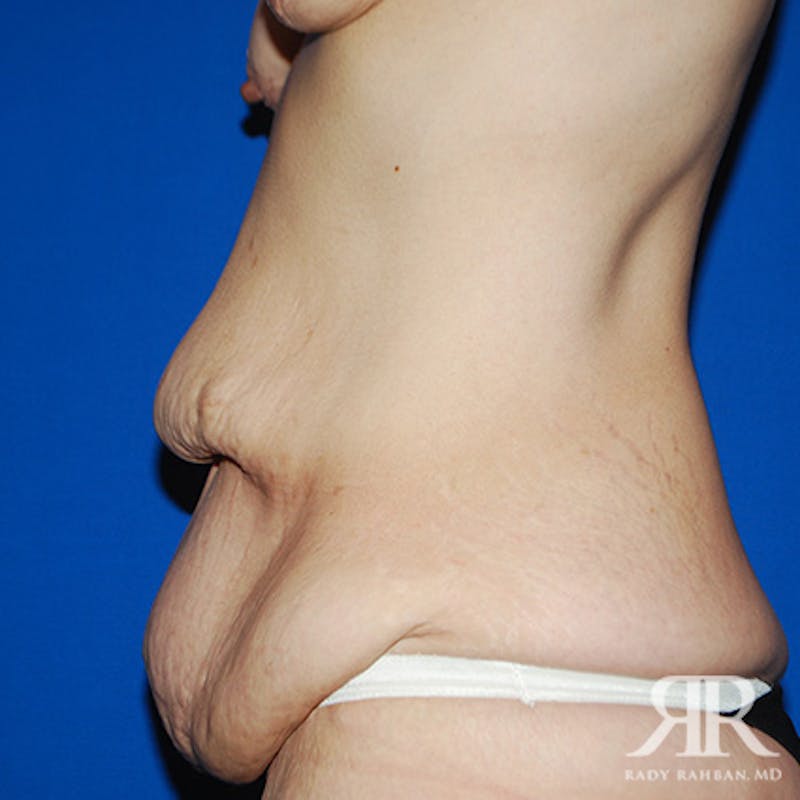 Tummy Tuck Before & After Gallery - Patient 364388 - Image 5