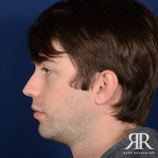 Chin Augmentation Before & After Gallery - Patient 301607 - Image 6