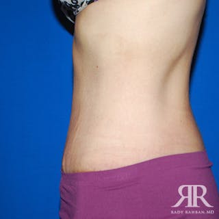Tummy Tuck Before & After Gallery - Patient 364388 - Image 6