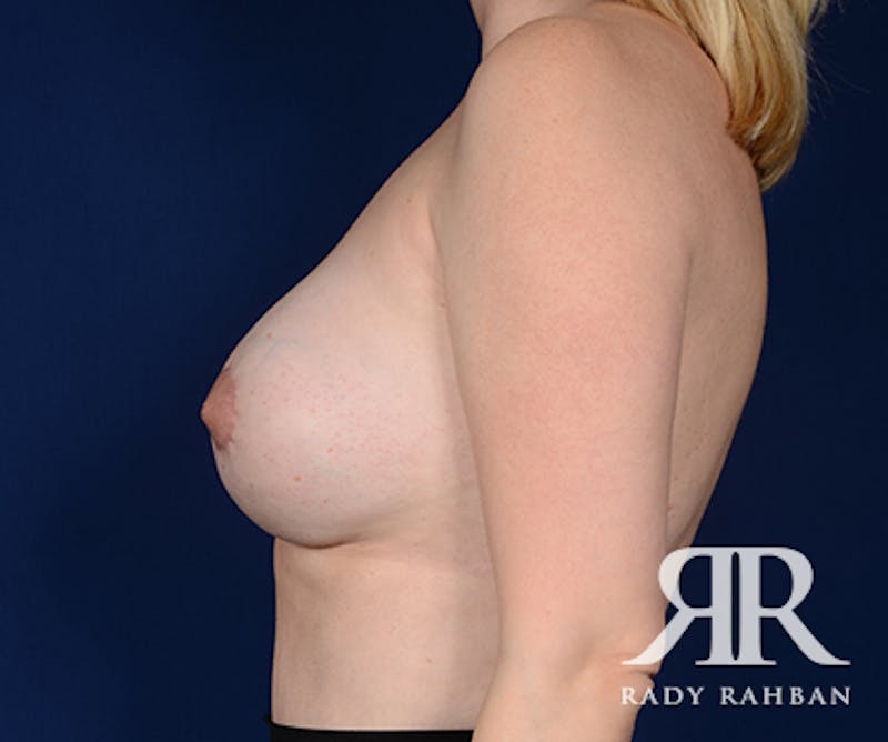 Corrective Breast Surgery Before & After Gallery - Patient 267073 - Image 6