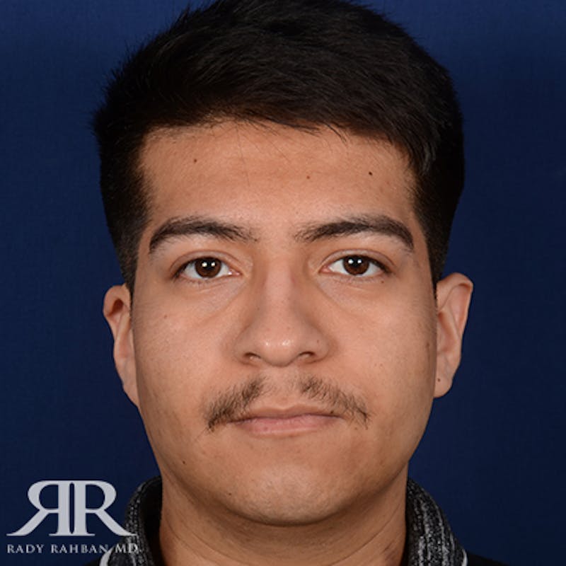 Chin Augmentation Before & After Gallery - Patient 112127 - Image 1