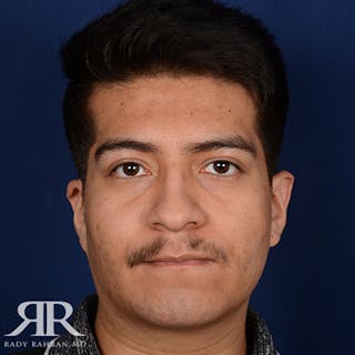 Chin Augmentation Before & After Gallery - Patient 112127 - Image 2