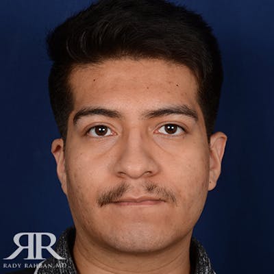 Chin Augmentation Before & After Gallery - Patient 112127 - Image 2