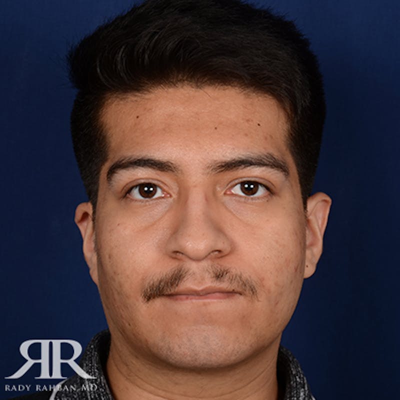 Chin Augmentation Before & After Gallery - Patient 112127 - Image 2