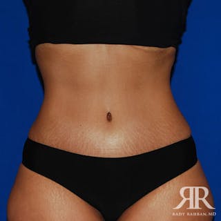 Tummy Tuck Before & After Gallery - Patient 212173 - Image 2