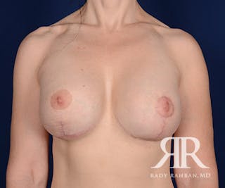 Corrective Breast Surgery Before & After Gallery - Patient 181103 - Image 2