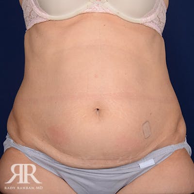Severe Diastasis Recti Before & After Gallery - Patient 409490 - Image 1