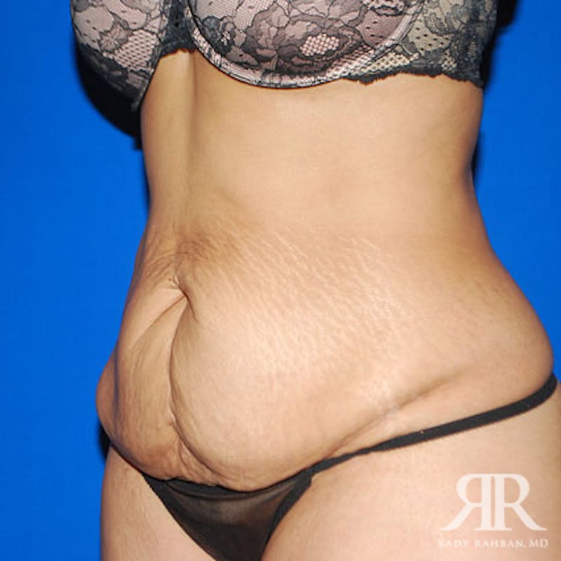 Tummy Tuck Before & After Gallery - Patient 212173 - Image 3