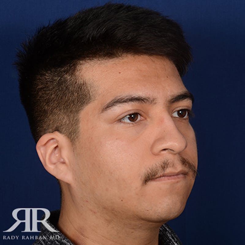 Chin Augmentation Before & After Gallery - Patient 112127 - Image 3