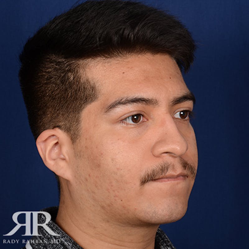 Chin Augmentation Before & After Gallery - Patient 112127 - Image 4