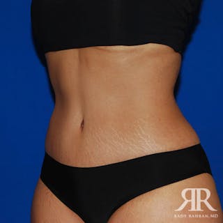Tummy Tuck Before & After Gallery - Patient 212173 - Image 4