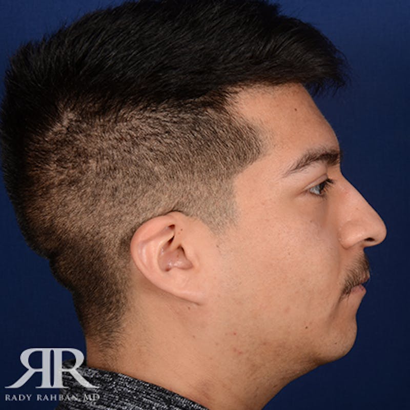 Chin Augmentation Before & After Gallery - Patient 112127 - Image 5