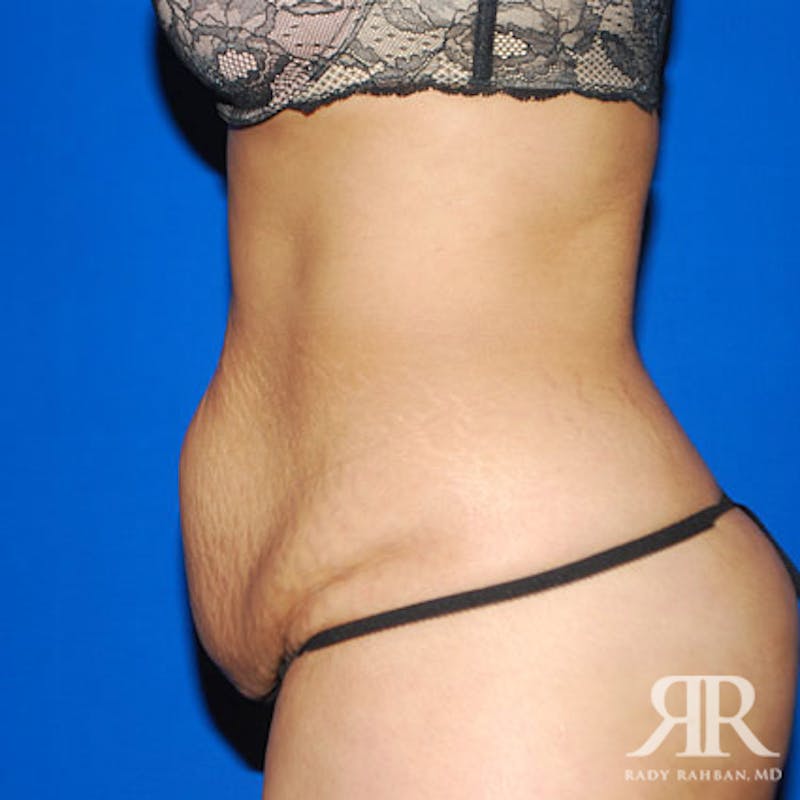 Tummy Tuck Before & After Gallery - Patient 212173 - Image 5