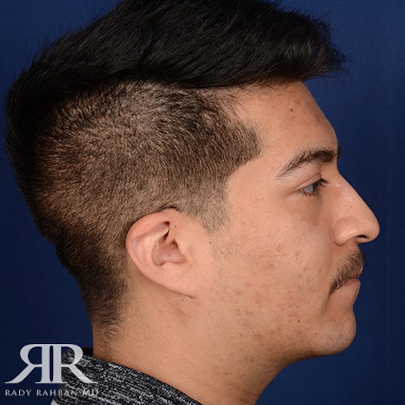 Chin Augmentation Before & After Gallery - Patient 112127 - Image 6