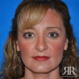 Ethnic Rhinoplasty Before & After Gallery - Patient 284177 - Image 2