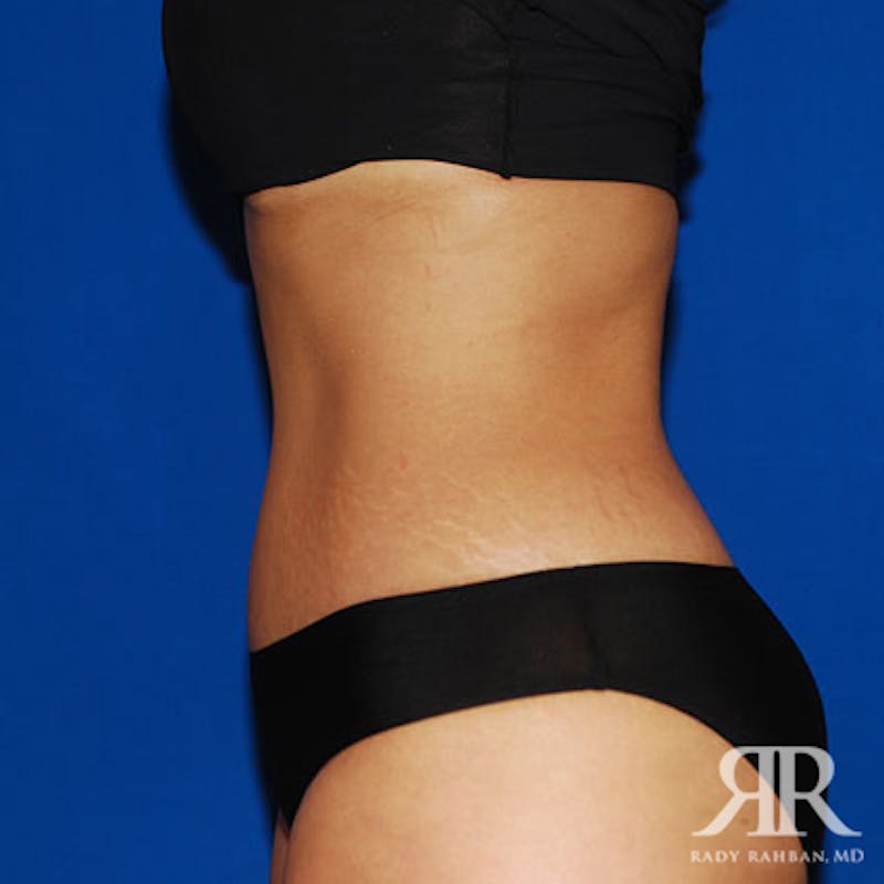 Tummy Tuck Before & After Gallery - Patient 212173 - Image 6