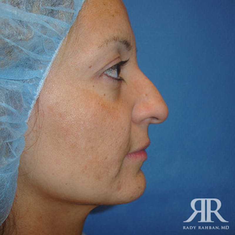 Ethnic Rhinoplasty Before & After Gallery - Patient 284177 - Image 3