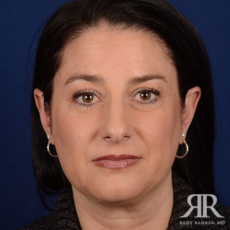 Female Rhinoplasty Before & After Gallery - Patient 147734 - Image 1