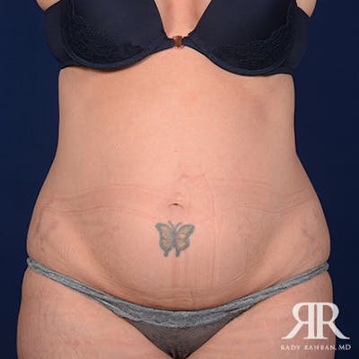 Tummy Tuck Before & After Gallery - Patient 177226 - Image 1