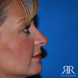 Ethnic Rhinoplasty Before & After Gallery - Patient 284177 - Image 4