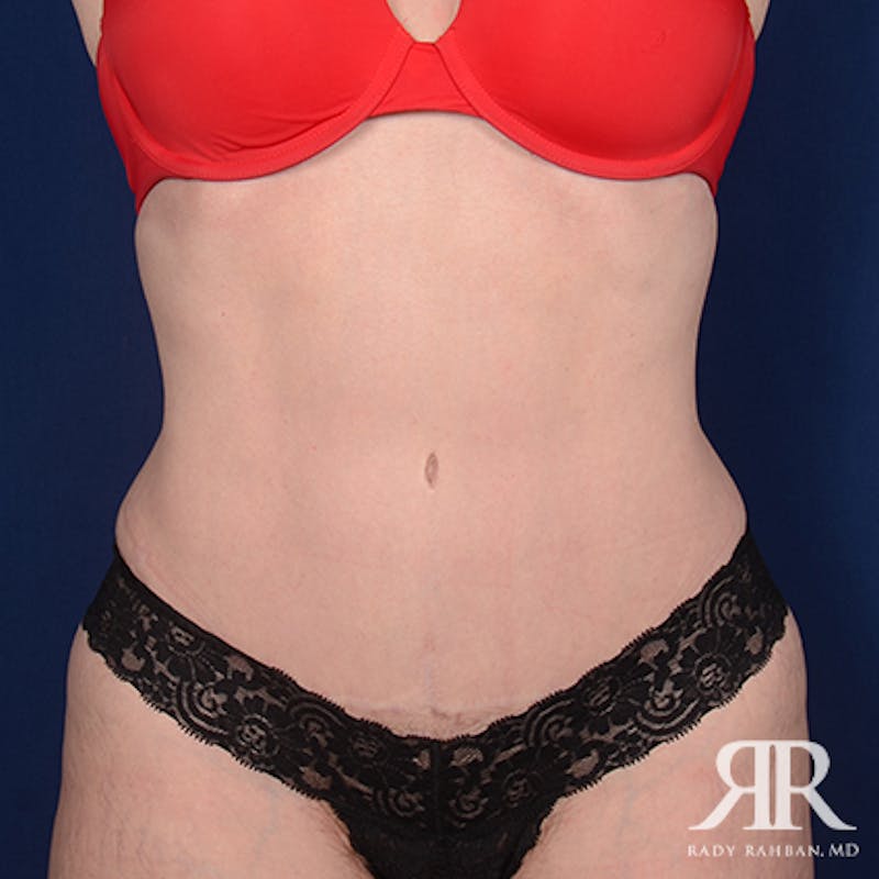 Tummy Tuck Before & After Gallery - Patient 177226 - Image 2