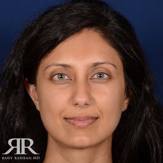 Chin Augmentation Before & After Gallery - Patient 204756 - Image 2