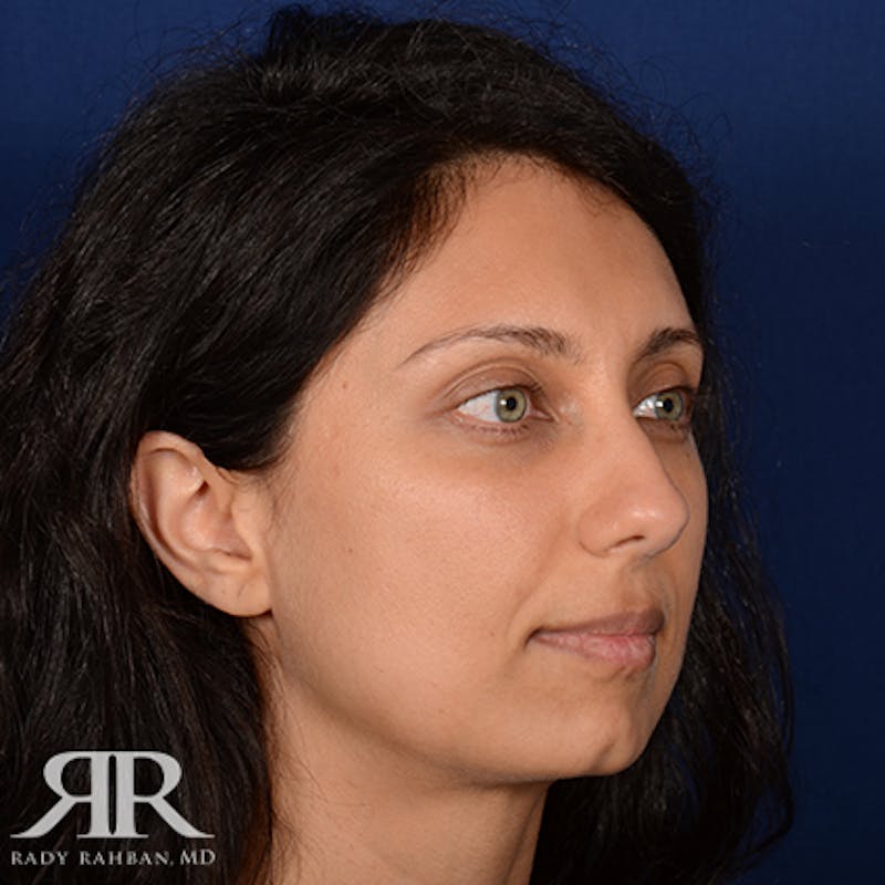 Chin Augmentation Before & After Gallery - Patient 204756 - Image 3