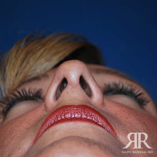 Ethnic Rhinoplasty Before & After Gallery - Patient 284177 - Image 6