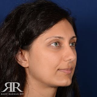 Chin Augmentation Before & After Gallery - Patient 204756 - Image 4