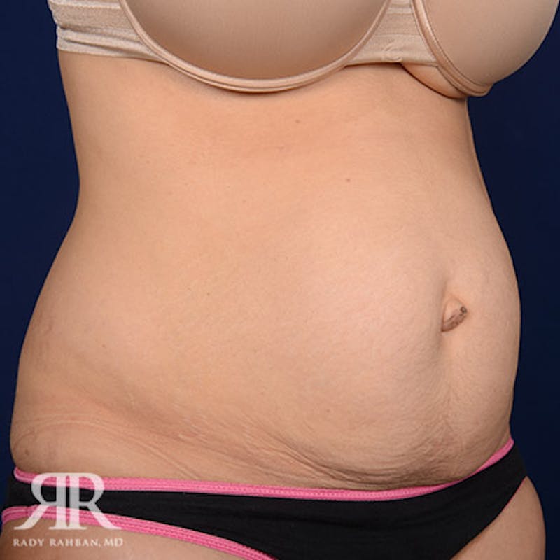 Severe Diastasis Recti Before & After Gallery - Patient 270780 - Image 3