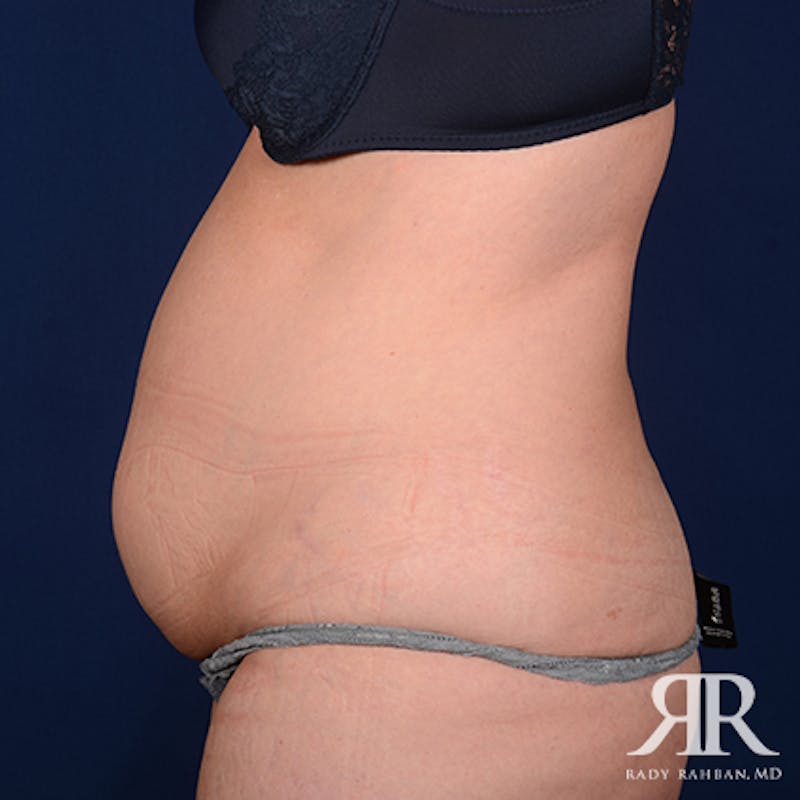 Tummy Tuck Before & After Gallery - Patient 177226 - Image 5