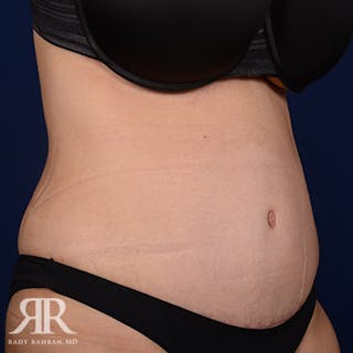 Severe Diastasis Recti Before & After Gallery - Patient 270780 - Image 4