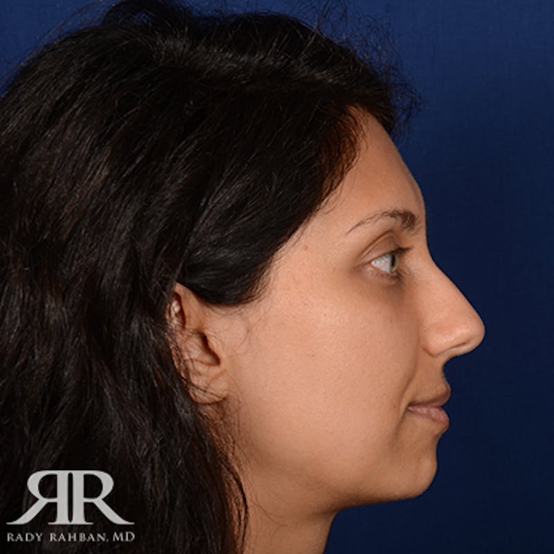 Chin Augmentation Before & After Gallery - Patient 204756 - Image 5
