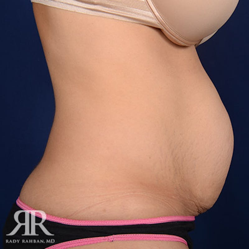 Severe Diastasis Recti Before & After Gallery - Patient 270780 - Image 5