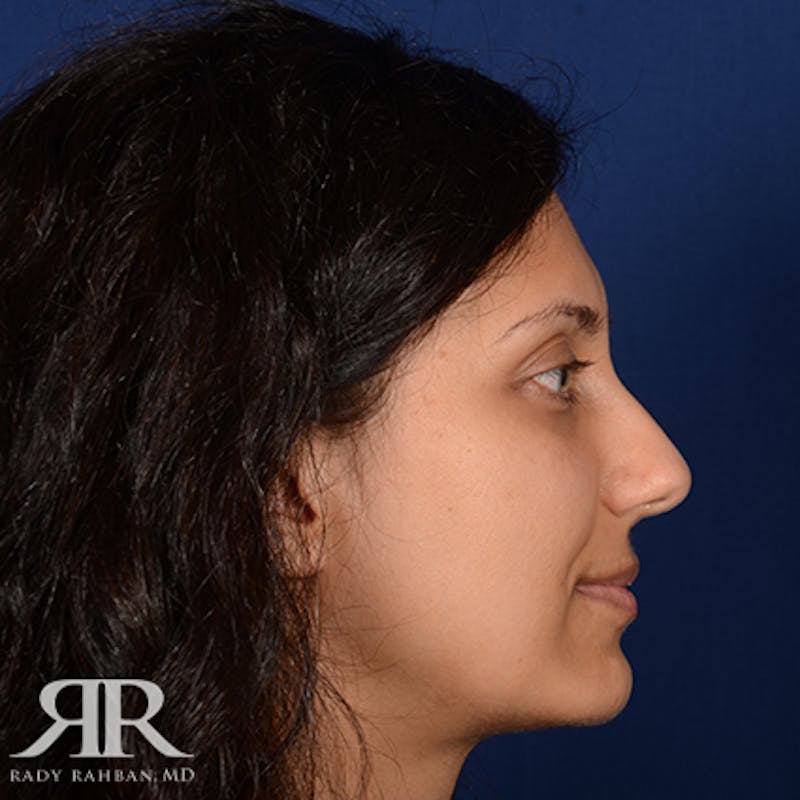 Chin Augmentation Before & After Gallery - Patient 204756 - Image 6