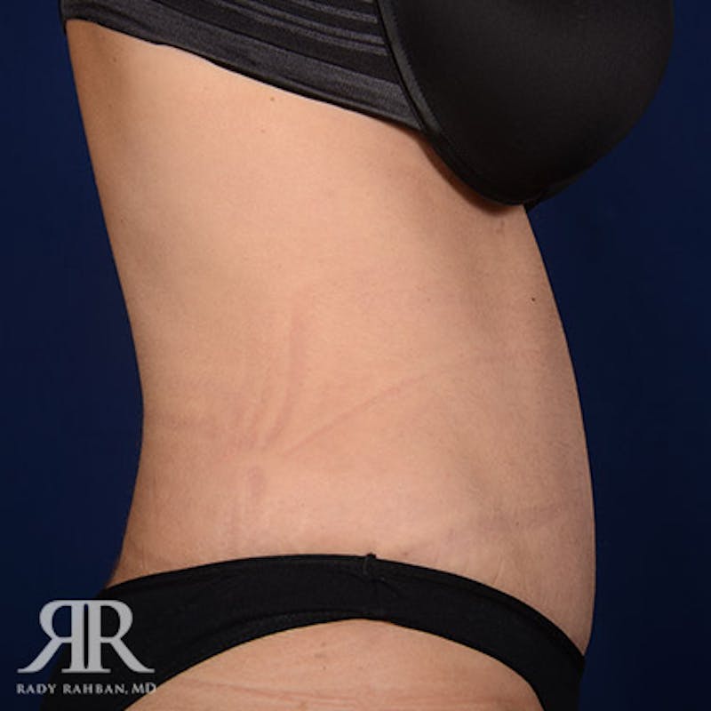 Severe Diastasis Recti Before & After Gallery - Patient 270780 - Image 6