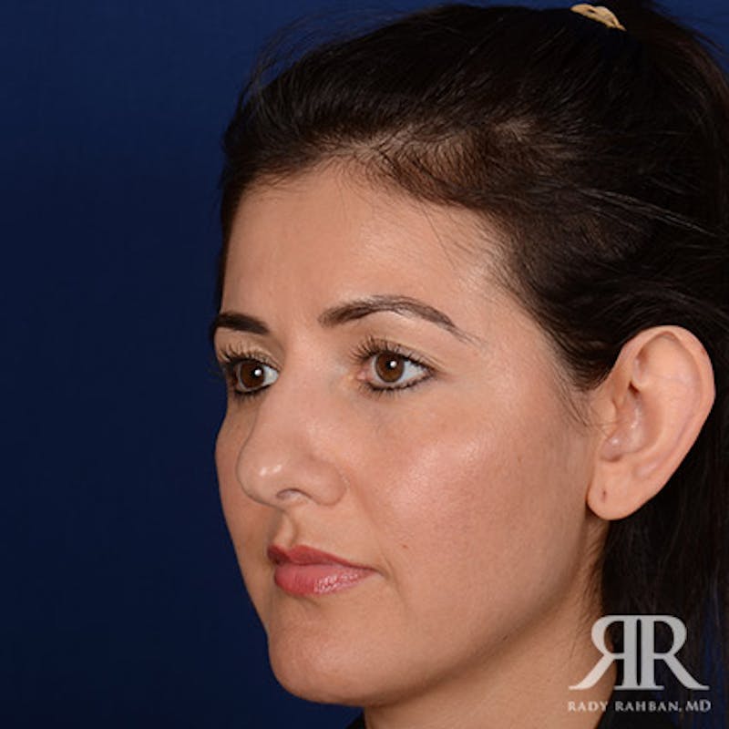 Ethnic Rhinoplasty Before & After Gallery - Patient 263947 - Image 3