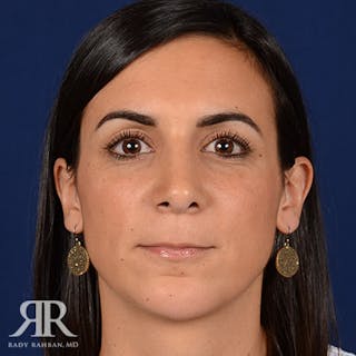 Female Rhinoplasty Before & After Gallery - Patient 162089 - Image 2