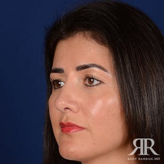 Ethnic Rhinoplasty Before & After Gallery - Patient 263947 - Image 4