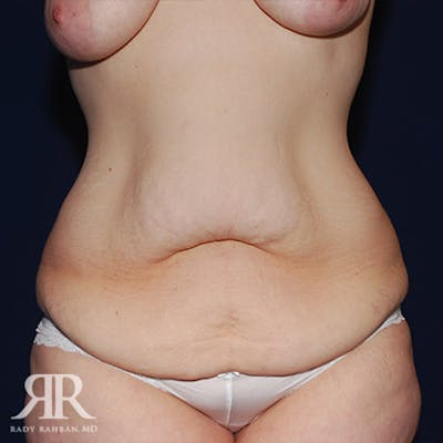 Tummy Tuck Before & After Gallery - Patient 101015 - Image 1